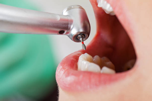 Best Emergency Dental Care for Broken or Chipped Teeth in El Segundo, CA